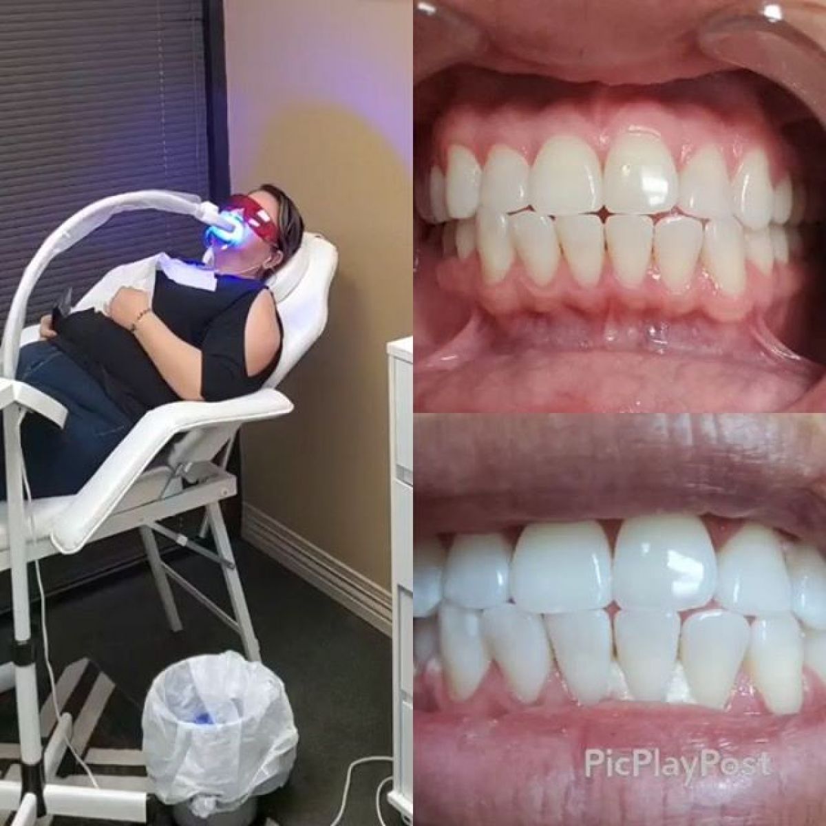 Blanchiment dentaire à Frontignan (34) Par Manon - Estheca