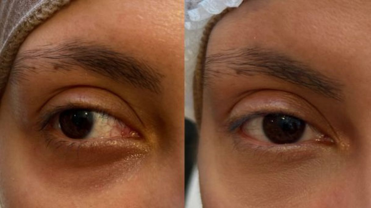 Flash eyes à Villeurbanne (69) Par Kenza - Estheca