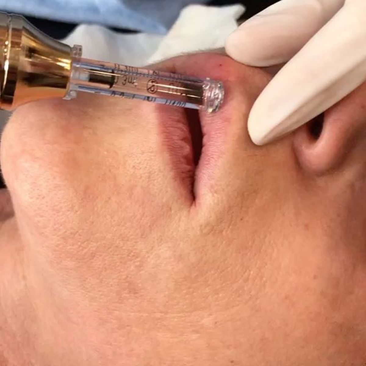 Augmentation lèvres Hyaluron pen à Alfortville (94) Par Laetitia - Estheca