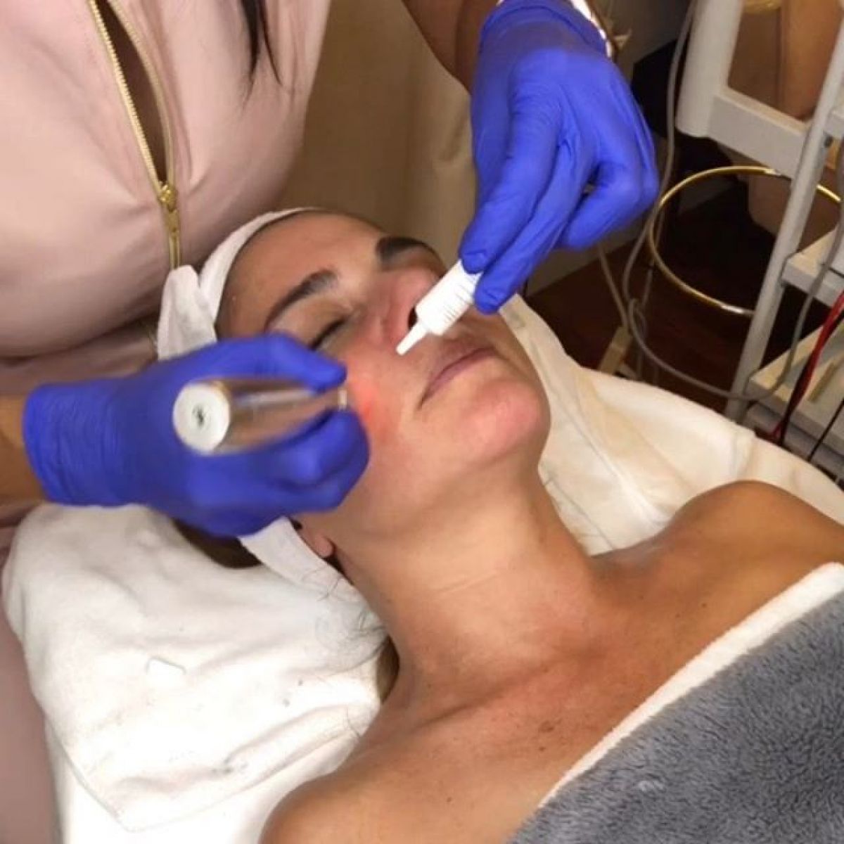 MicroNeedling BB Glow à Évry (91) Par Aline - Estheca