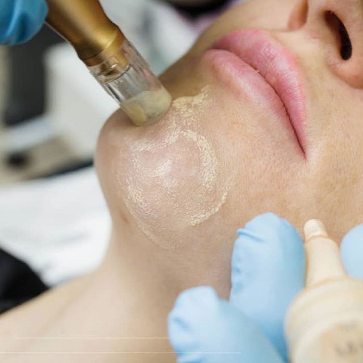 MicroNeedling BB Glow à Antibes (06) Par Samantha - Estheca