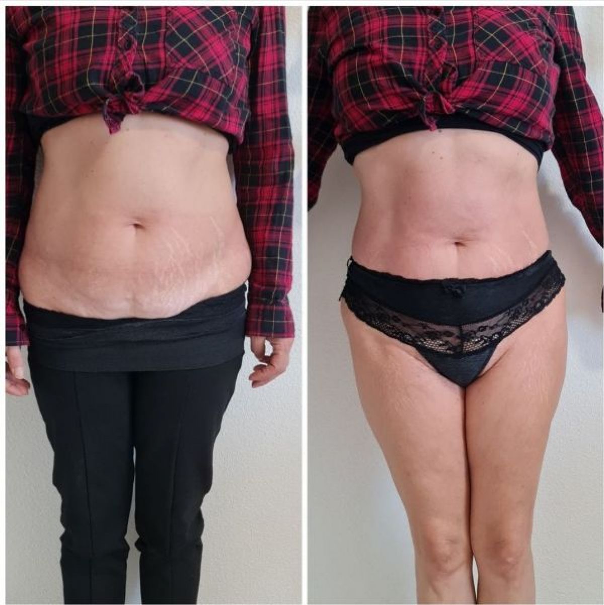 Amincissement et remodelage par lipocavitation / Radiofréquence à Meaux (77) Par Lilya - Estheca