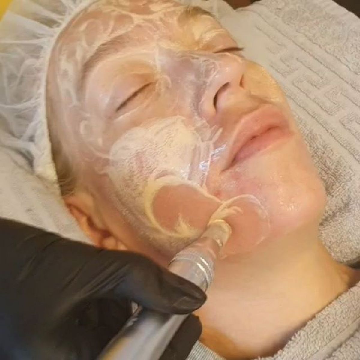 MicroNeedling BB Glow à Rueil-Malmaison (92) Par Sandrine - Estheca