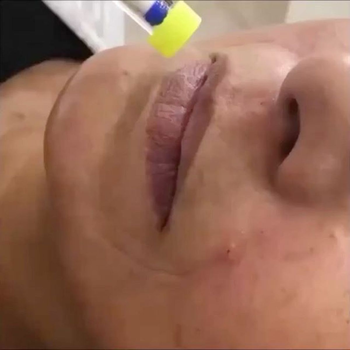Hyaluron pen Lèvres à Lingolsheim (67) Par Camille - Estheca