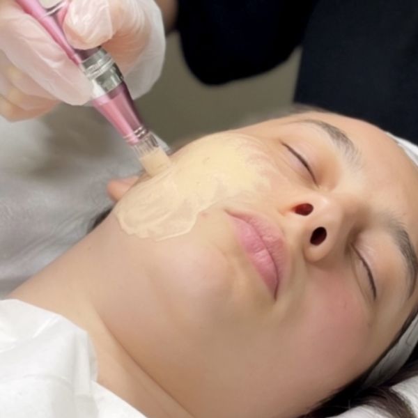 À Toulon | Microneedling BB GLOW | Les meilleures esthéticiennes