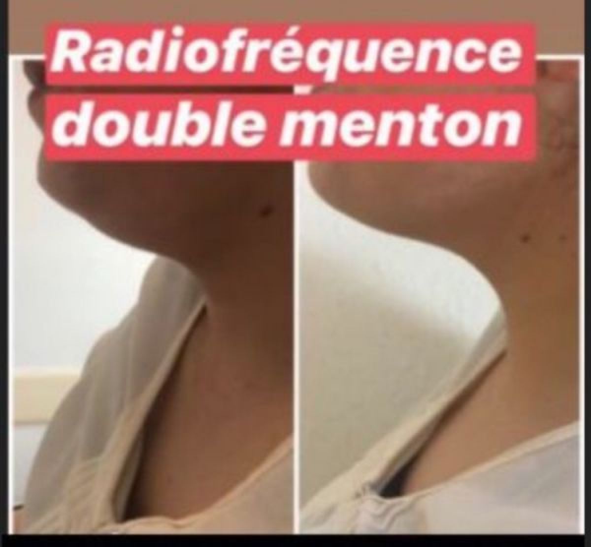 Lipocavitation et radiofréquence  à Tourcoing (59) Par Sarah - Estheca