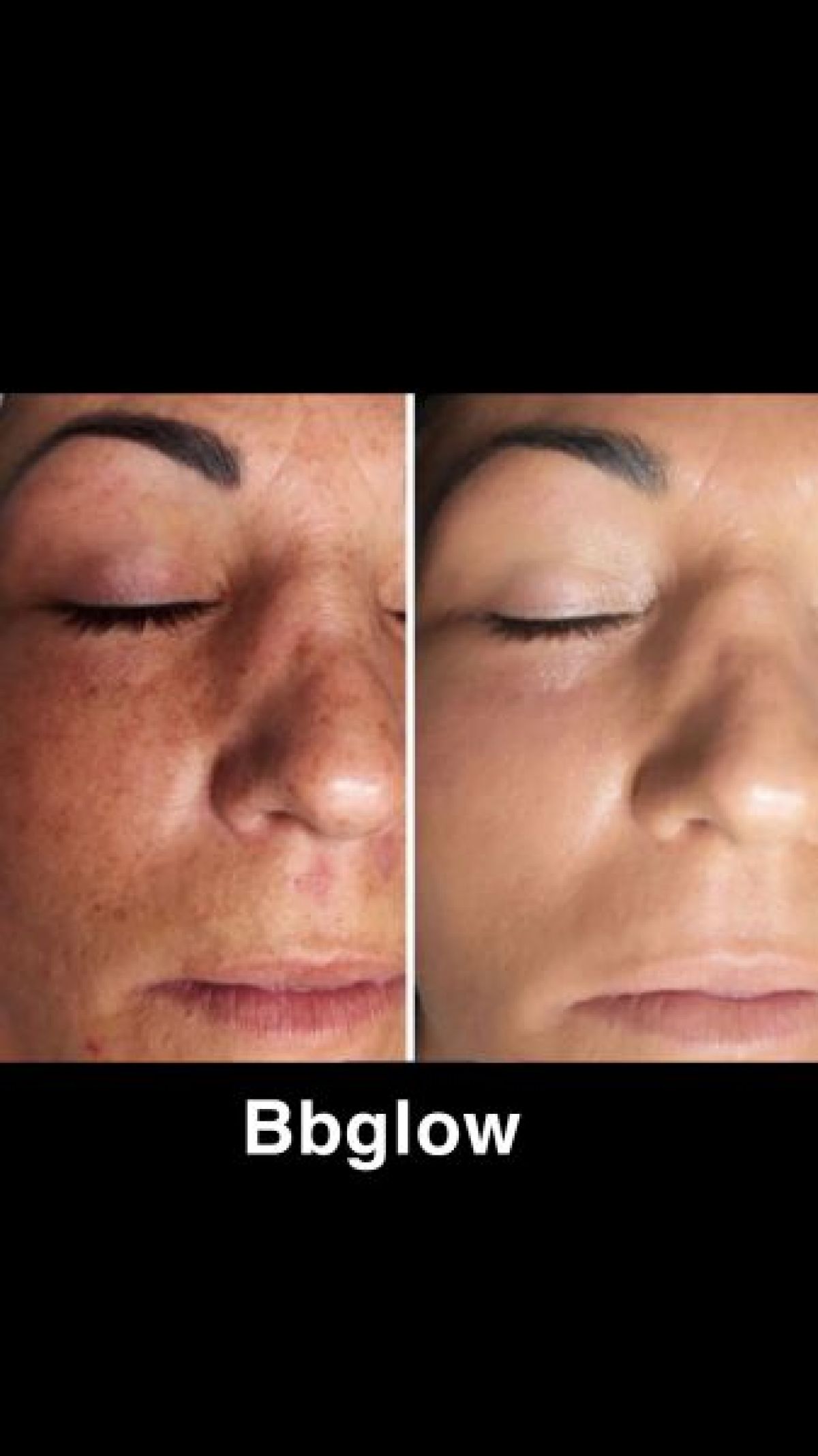 Microneedling / BB Glow à Tourcoing (59) Par Sarah - Estheca