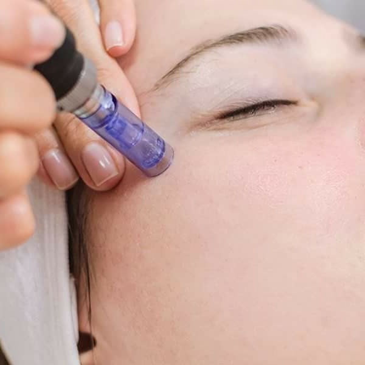 MicroNeedling BB Glow à Balma (31) Par Chloé - Estheca