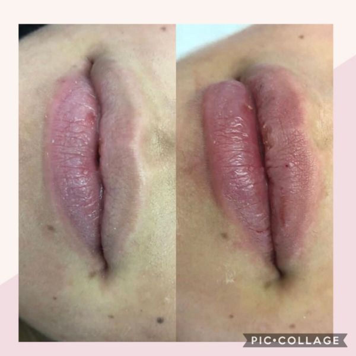 Augmentation des lèvres/ comblement des rides à Lille (59) Par Nassera - Estheca
