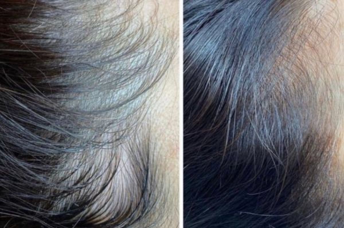 Hairneedling à Terville (57) Par Besma - Estheca