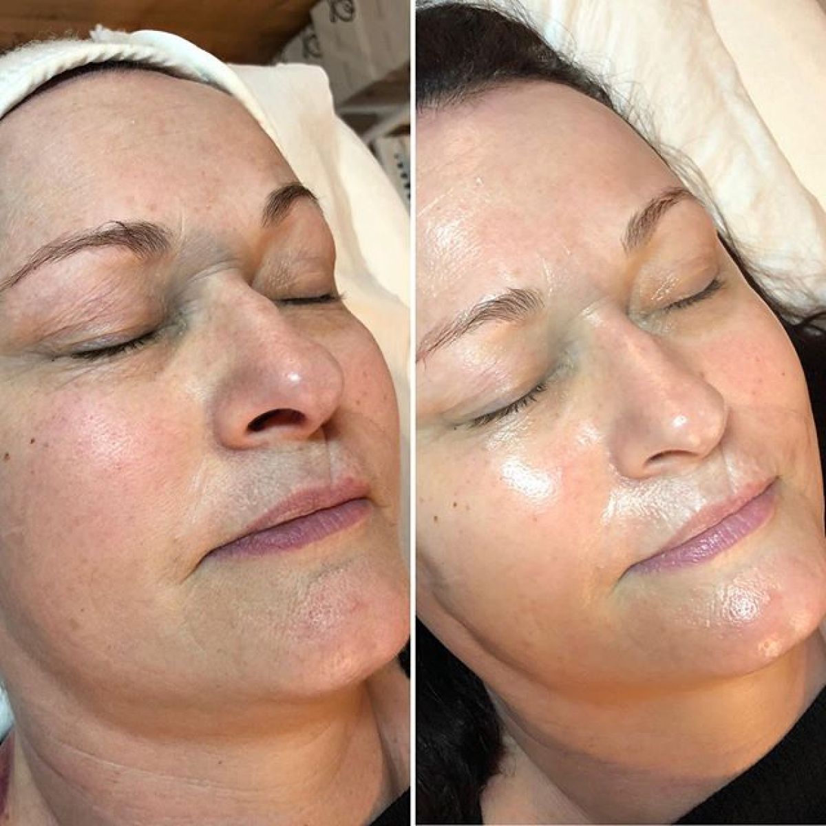 MicroNeedling BBGlow à Vitry-sur-Seine (94) Par Angélique - Estheca