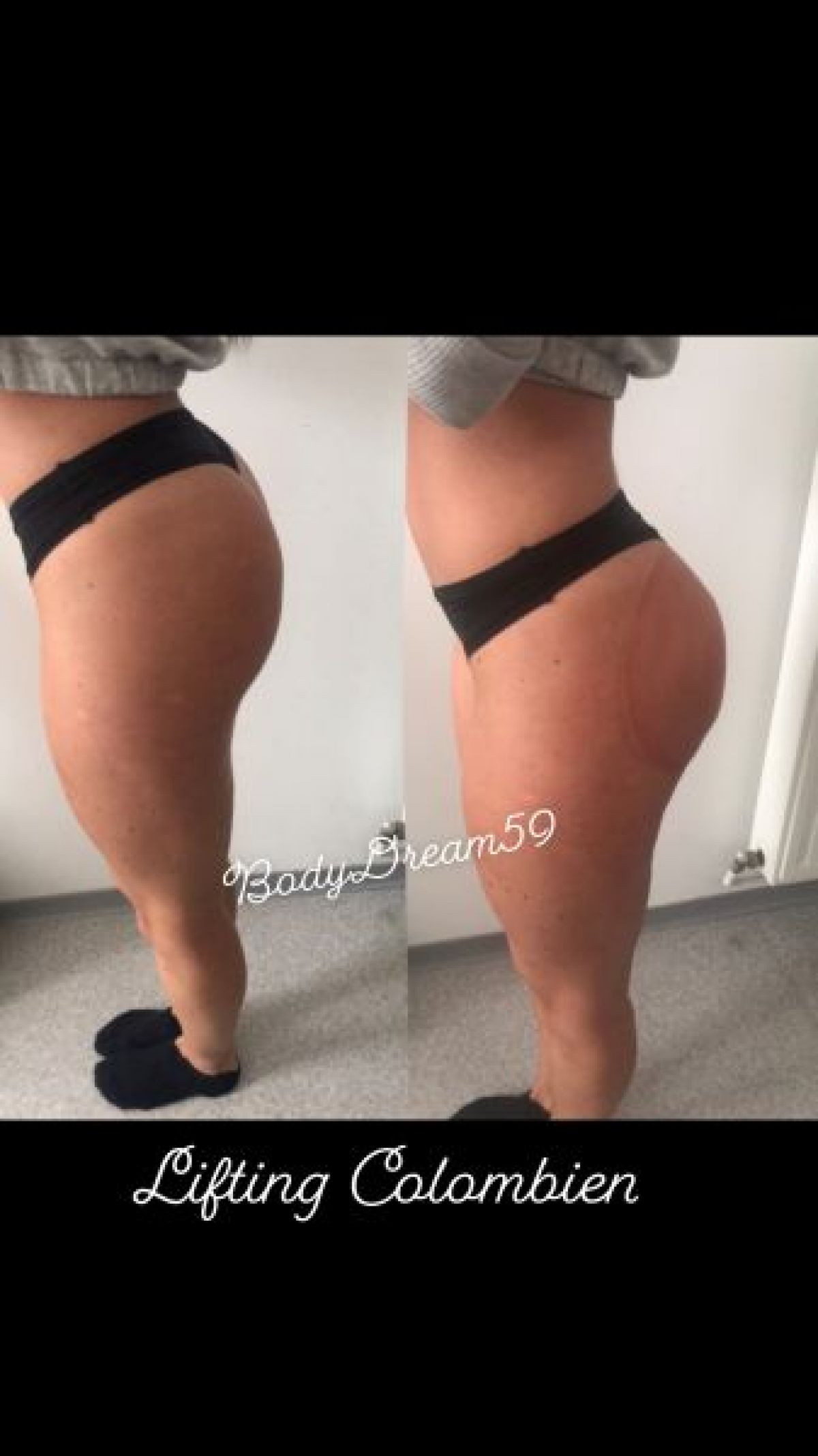 Lifting colombien et anti cellulite  à Tourcoing (59) Par Sarah - Estheca