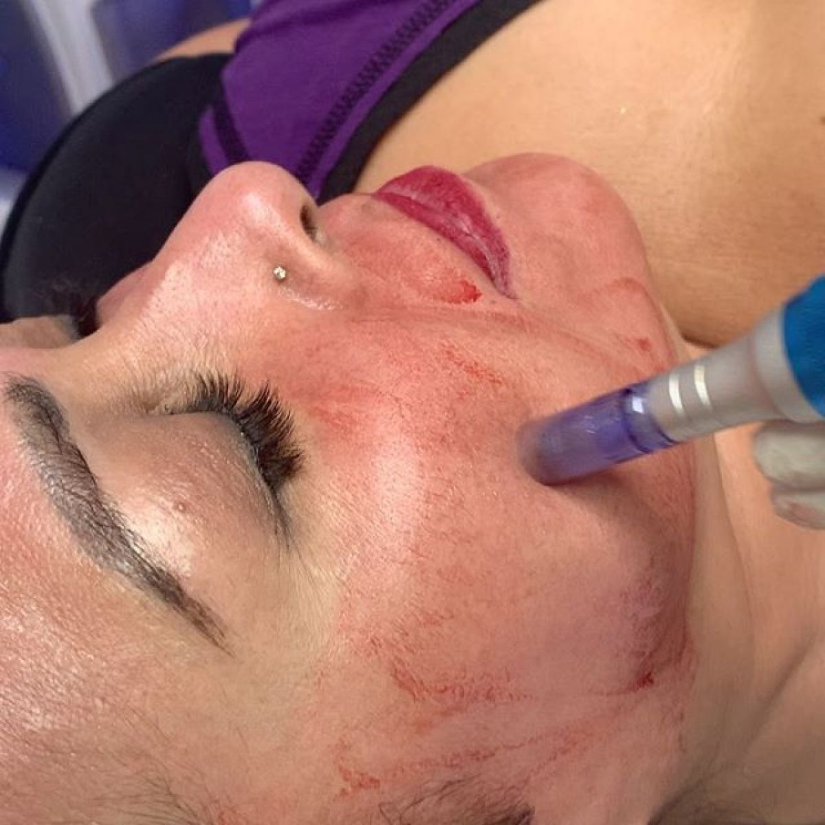 MicroNeedling BB Glow à Le Pradet (83) Par Stacie - Estheca