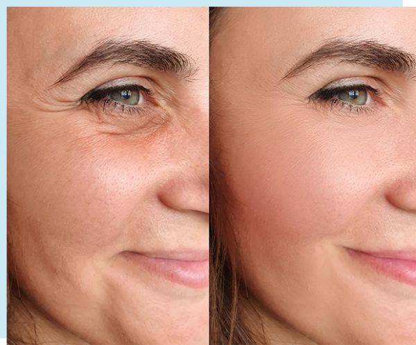 À Palaiseau | Mesolift /Skin  booster / soin anti rides  | Les meilleures esthéticiennes