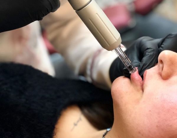 À Cannes | Augmentation des lèvres par Hyaluron Pen | Les meilleures esthéticiennes