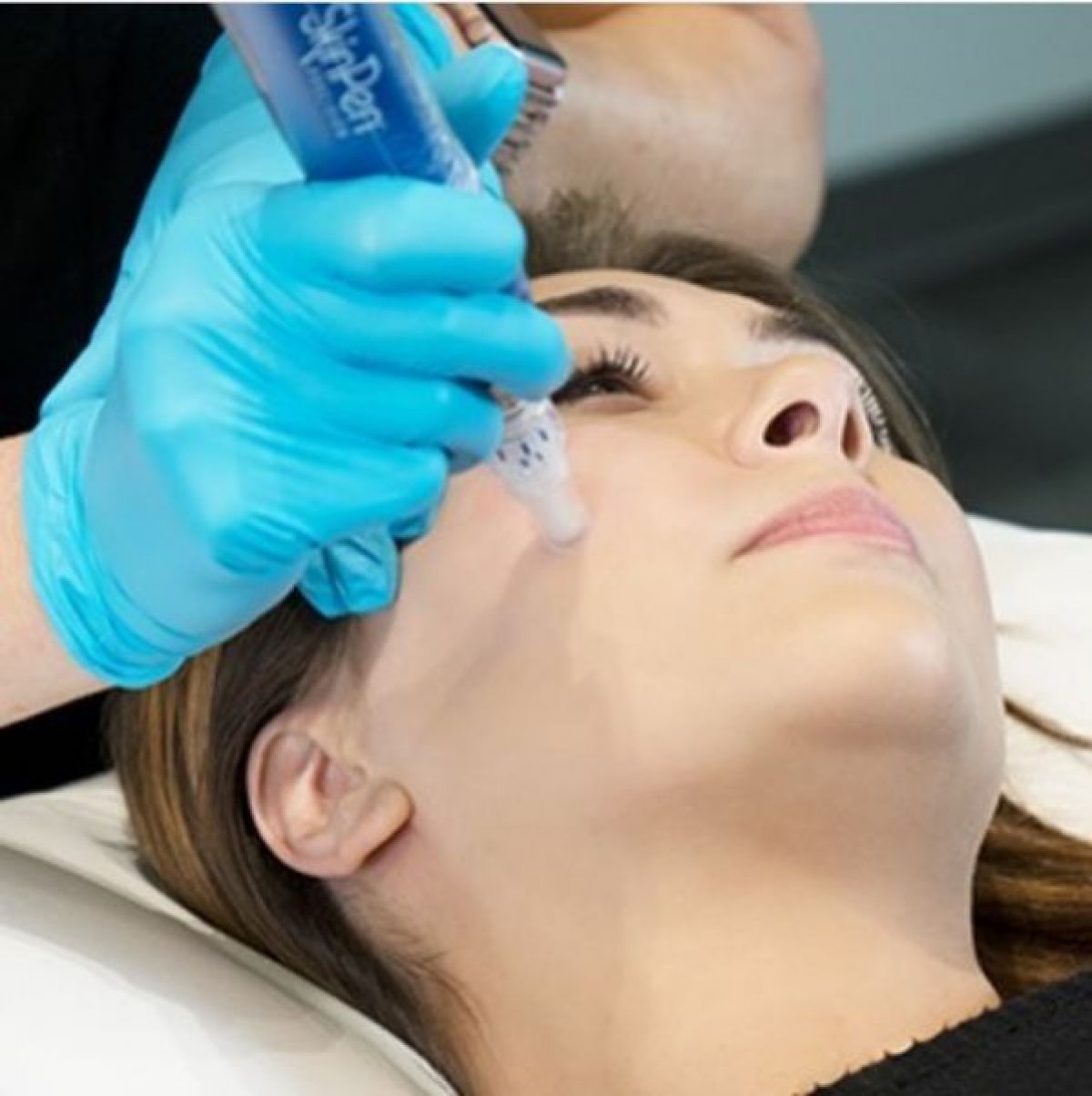 Microneedling BB Glow  à Reims (51) Par Coralie - Estheca