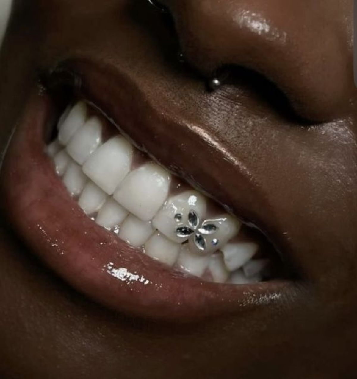 Strass dentaire à Cornebarrieu (31) Par Maria - Estheca