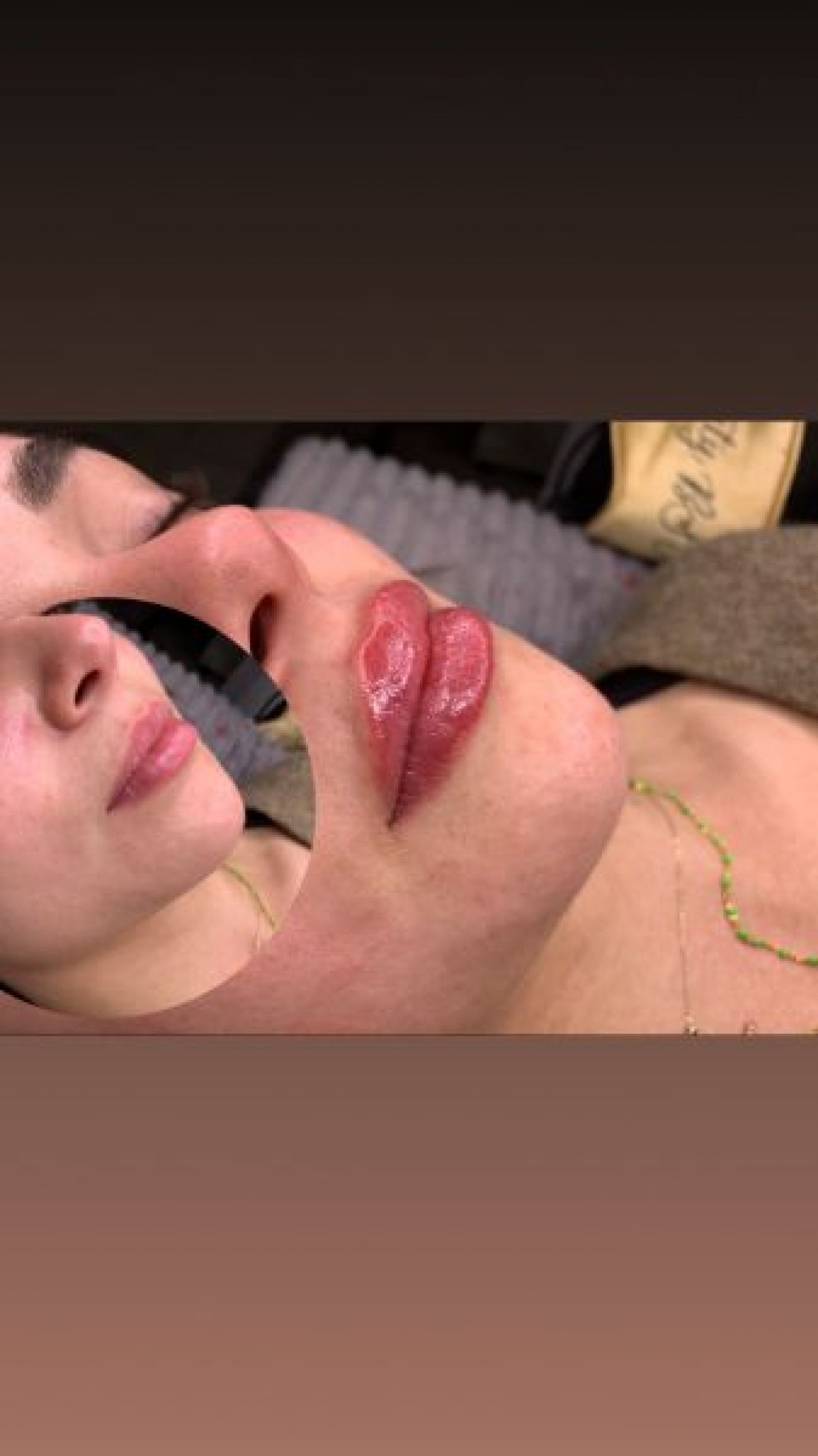 Injections d’acide hyaluronique  lèvres à Reims (51) Par Mery - Estheca