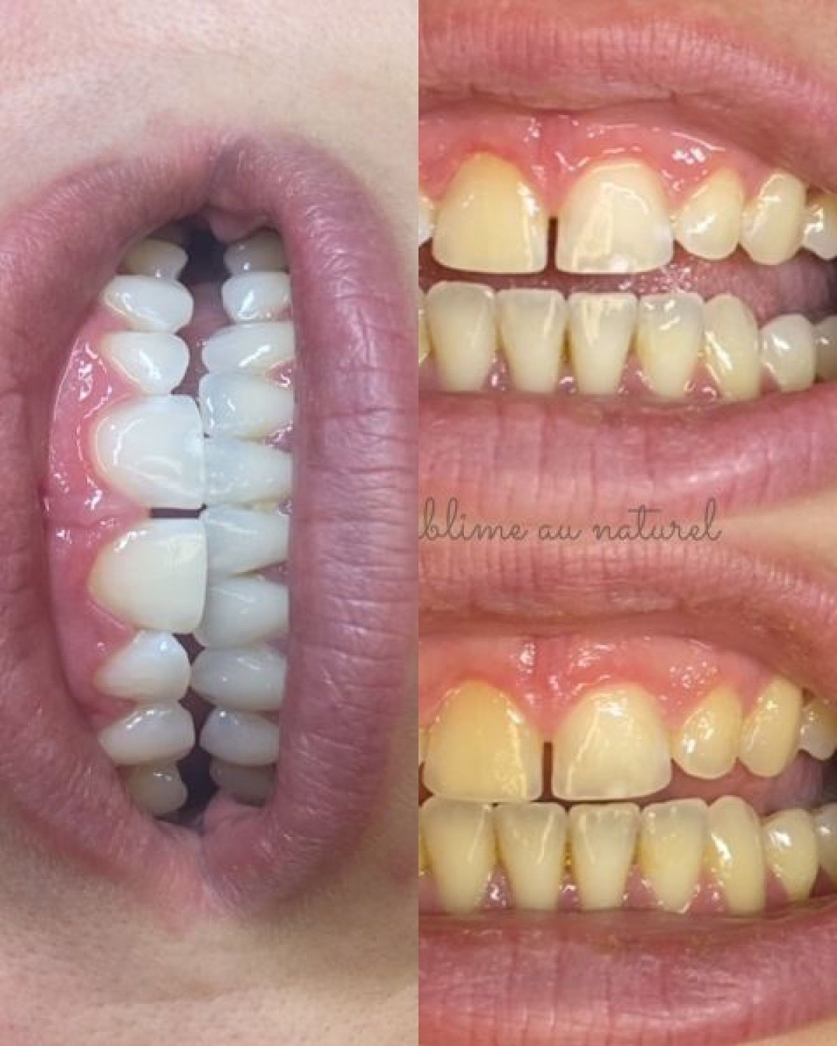 Blanchiment dentaire à Guénange (57) Par Magalie - Estheca