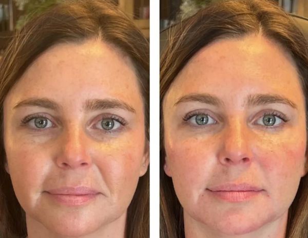 À Massy | SkinBooster EXOSOME Coréen  ( Anti-âge) | Les meilleures esthéticiennes