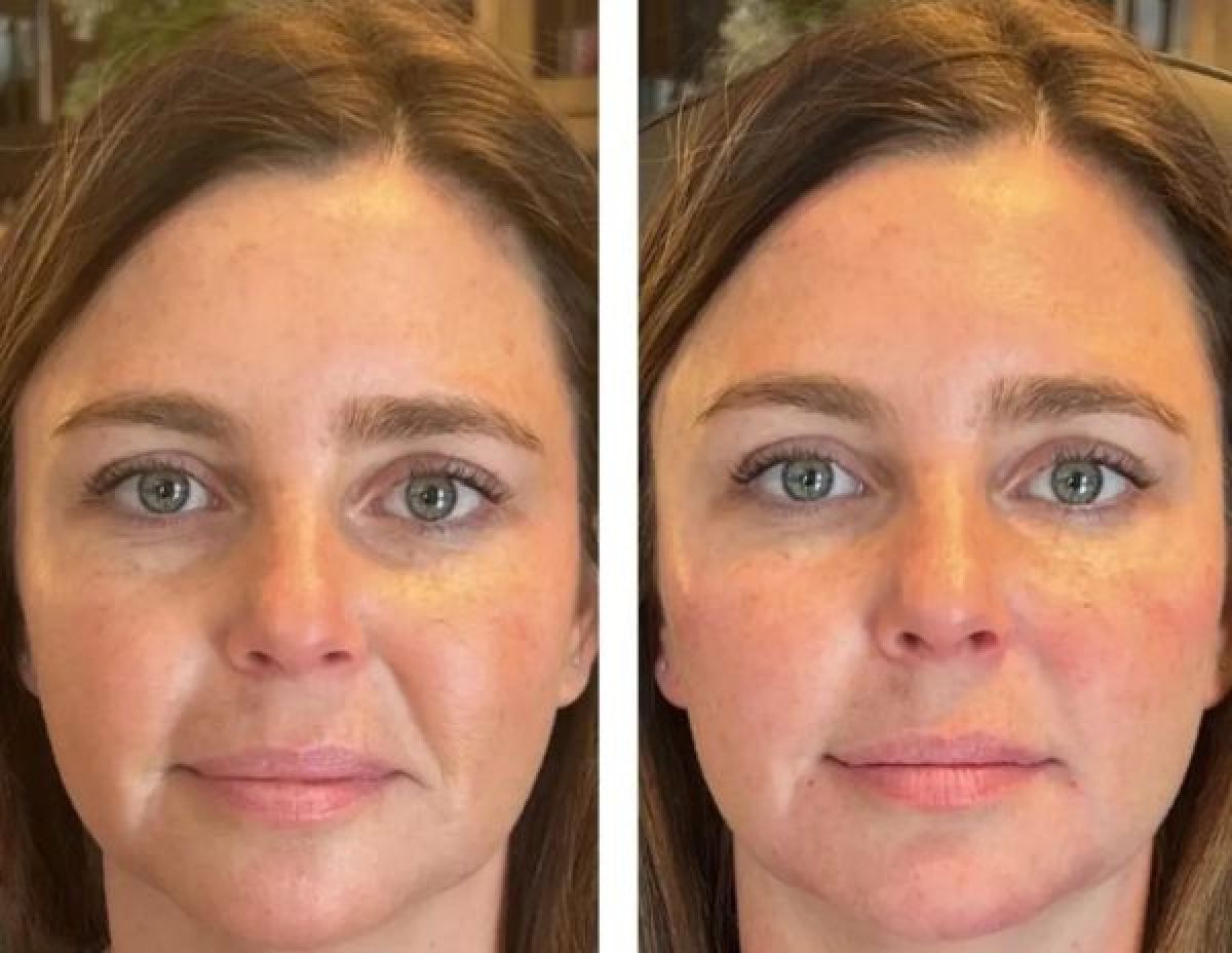 SkinBooster EXOSOME Coréen  ( Anti-âge) à Massy (91) Par Samya - Estheca