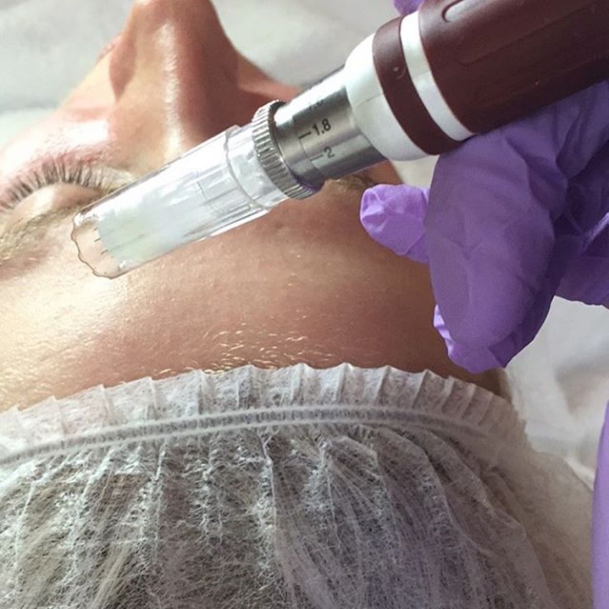 MicroNeedling BB Glow à Mérignac (33) Par Samantha - Estheca