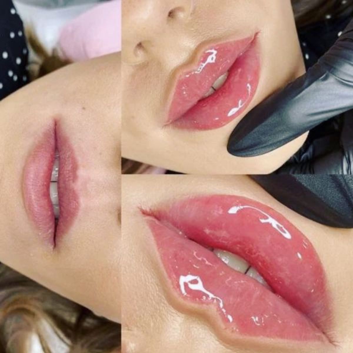 Russian lips Injection avec l’acide Hyaluronique à Saint-Jory (31) Par Gaëlle - Estheca