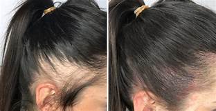 À Marseille | Micropigmentation du cuir chevelu | Les meilleures esthéticiennes