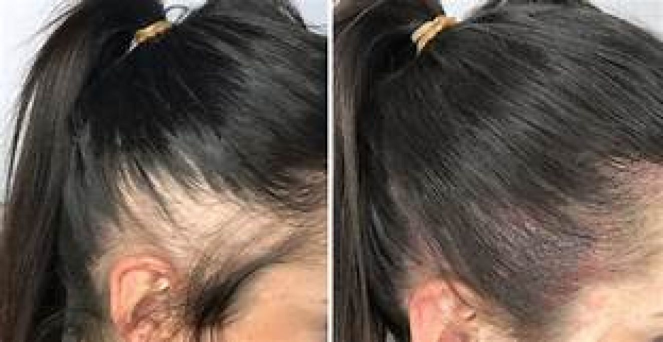 Micropigmentation du cuir chevelu à Marseille (13) Par Julie - Estheca