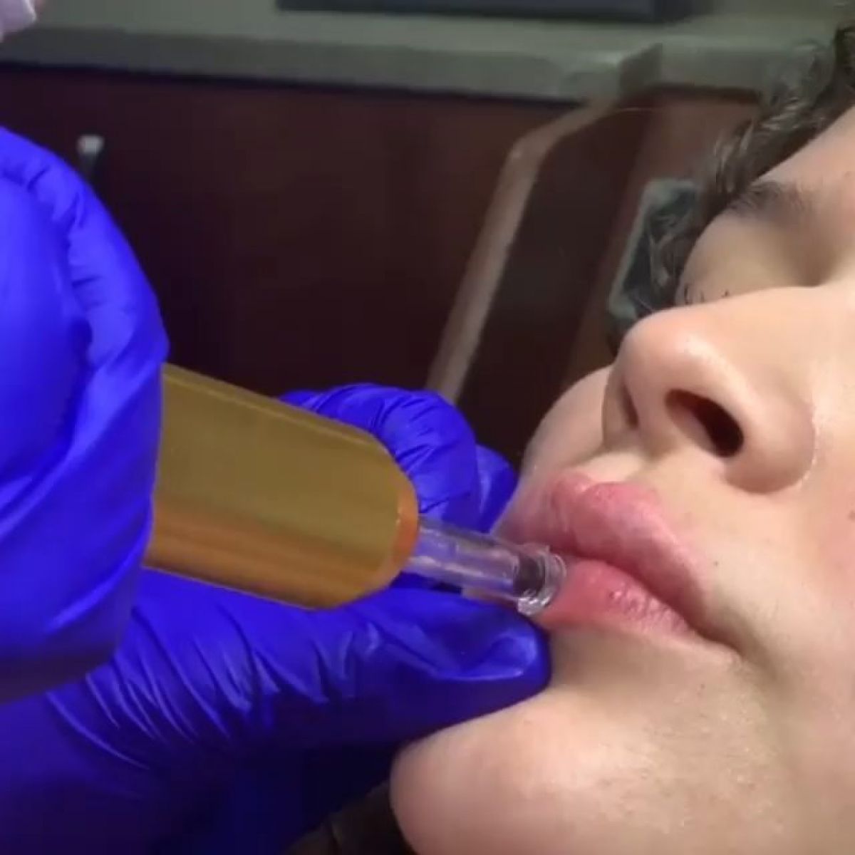 Augmentation lèvres Hyaluron pen à Arques-la-Bataille (76) Par Alicia - Estheca