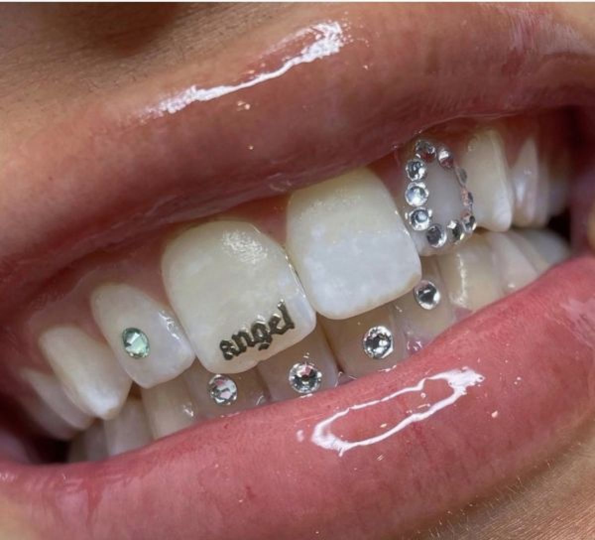 Bijoux dentaire à Chatou (78) Par Cassandra - Estheca