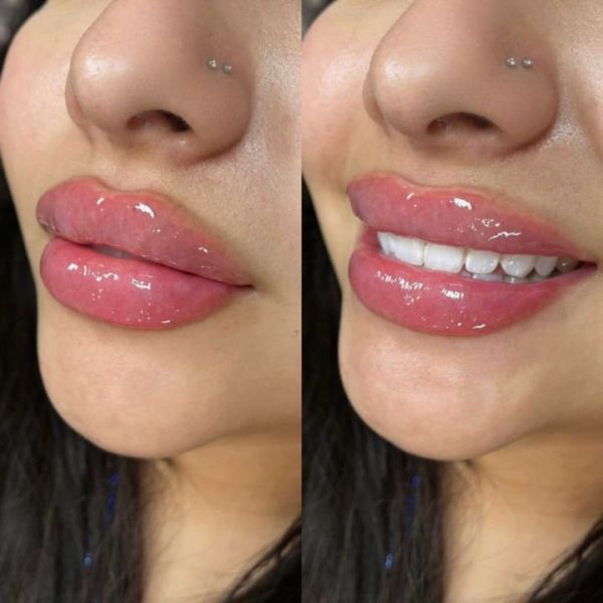 Russian lips, augmentation des lèvres, rides du lion et sillons sans injection à Lagny-sur-Marne (77) Par Mary-Khaby - Estheca