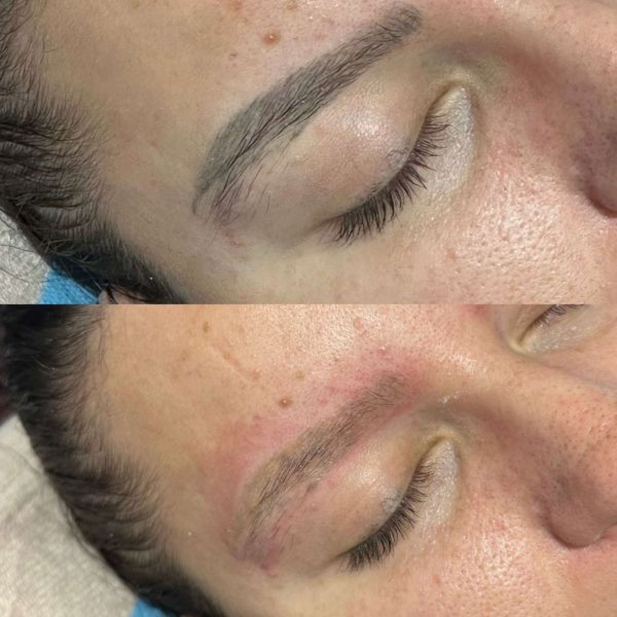 Detatouage Laser à Noisy-le-Grand (93) Par Nassima - Estheca