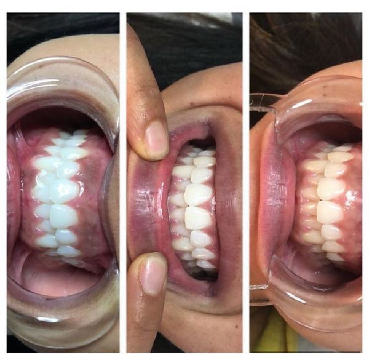 Blanchiment dentaire médicalisé  à Lille (59) Par Nassera - Estheca