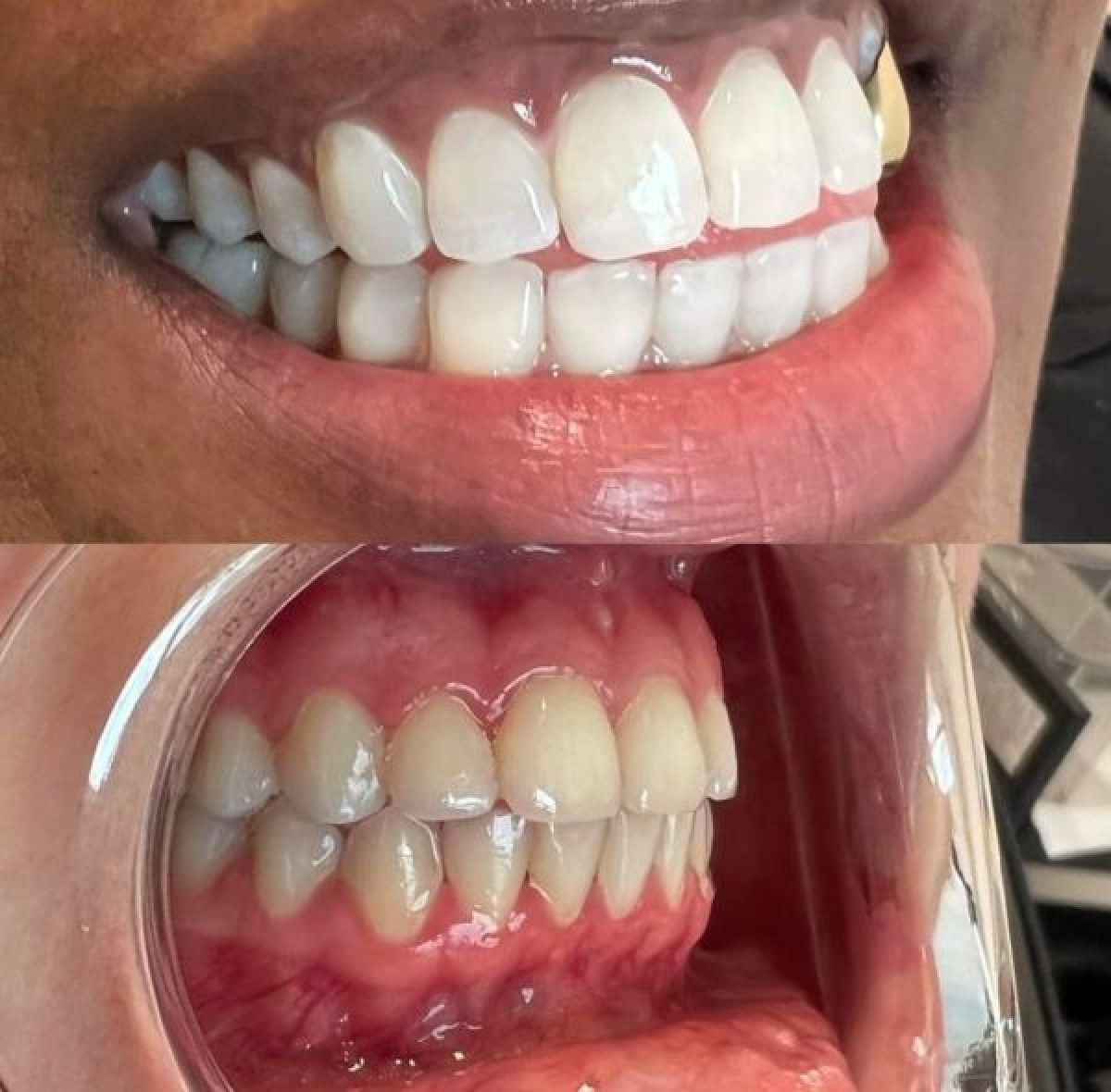 Blanchiment dentaire à Champagnier (38) Par Sofia - Estheca