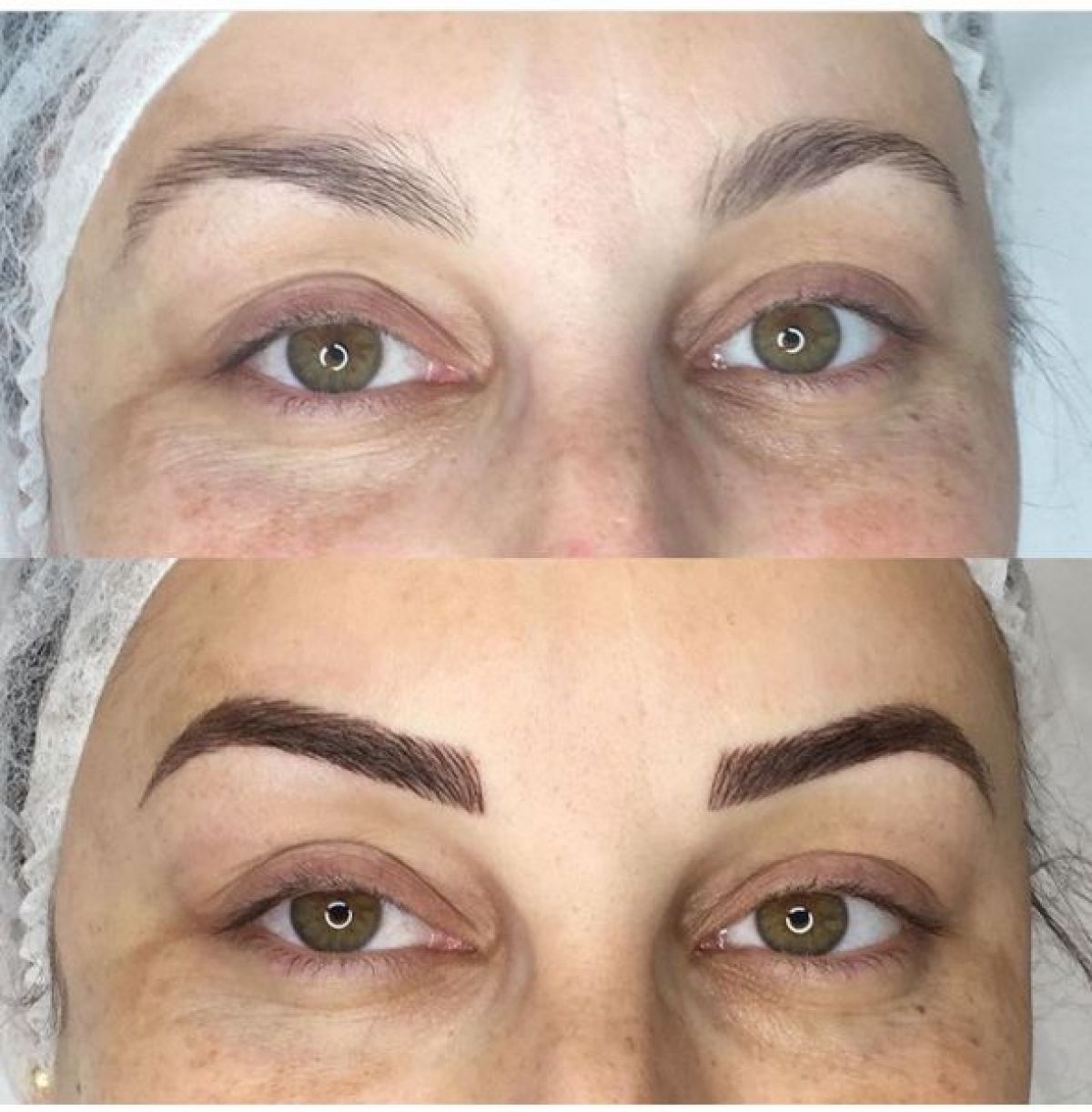 Microbalding  à Lille (59) Par Mathilde - Estheca