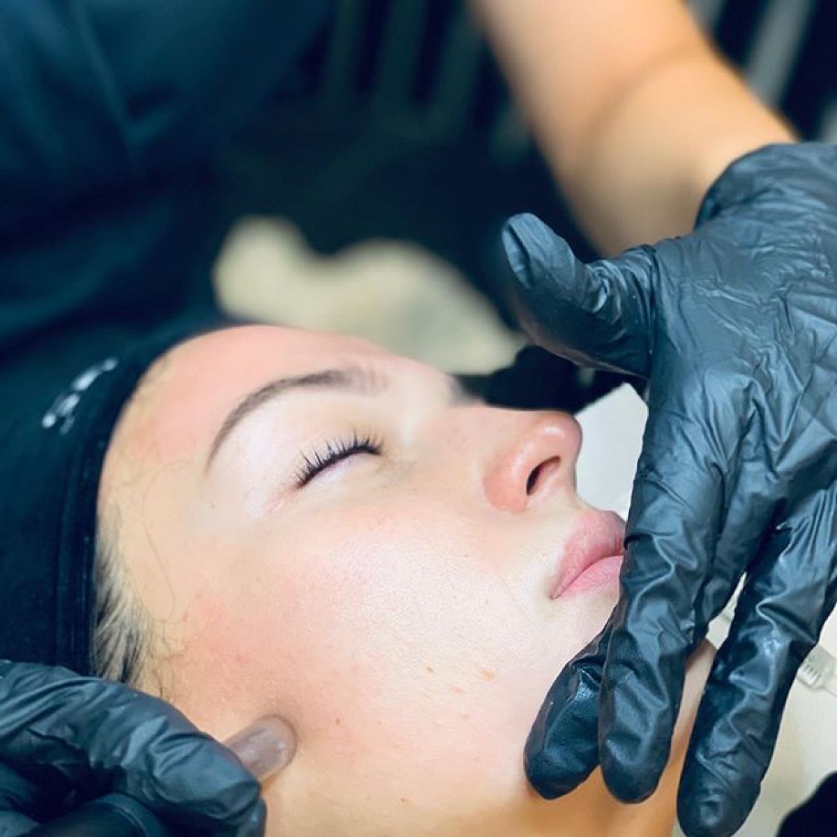 MicroNeedling BB Glow à Saint-Orens-de-Gameville (31) Par Clémence - Estheca