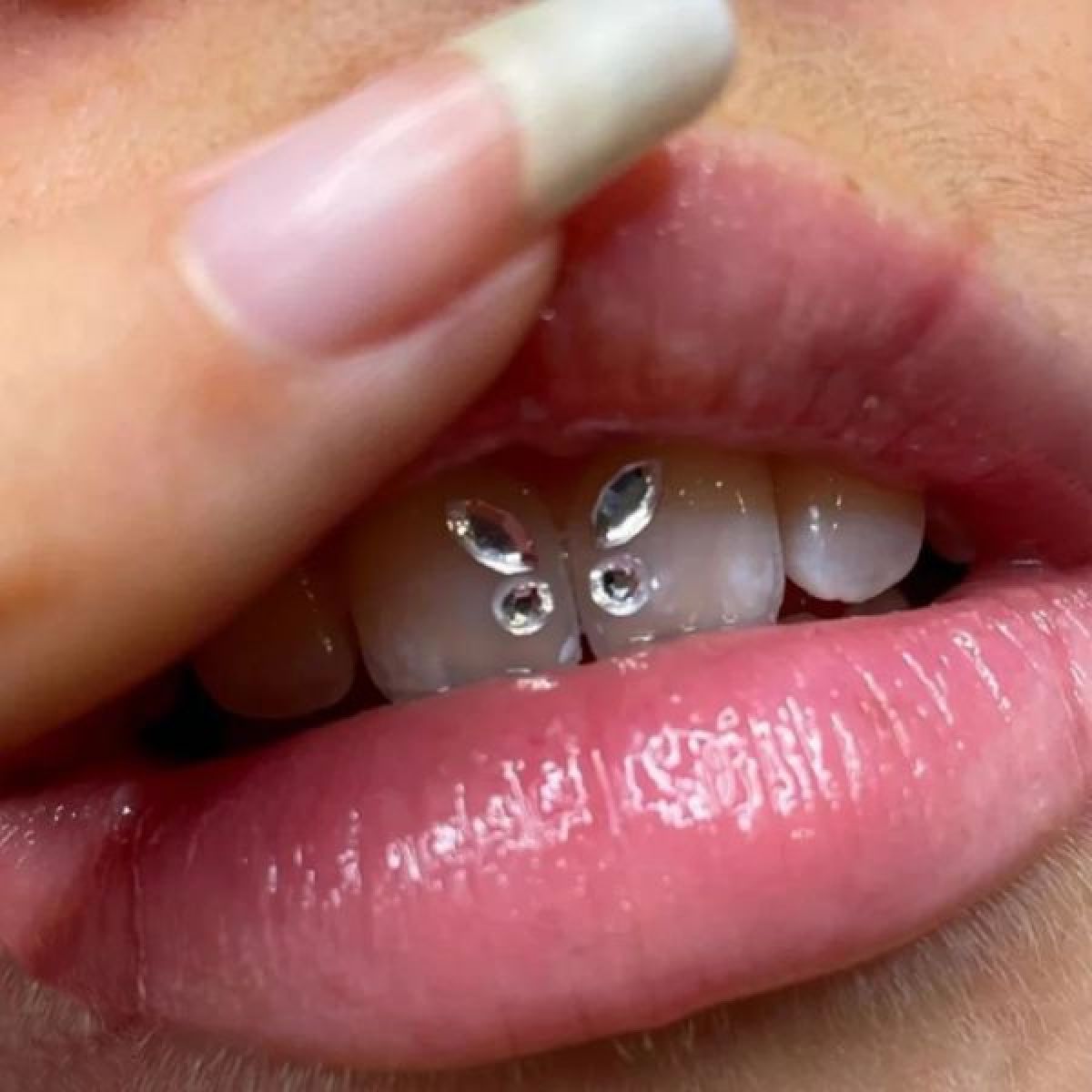 Strass Dentaire Pro à Lyon (69) Par Zahidé Estheca