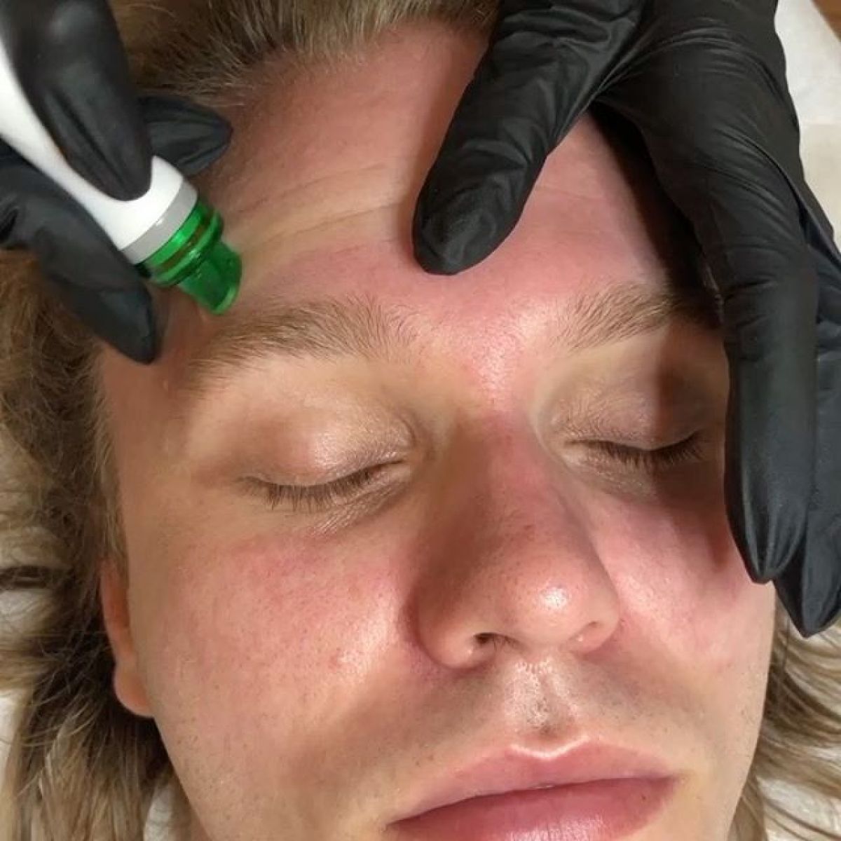 MicroNeedling BB Glow à Saint-Priest (69) Par Stéphanie - Estheca