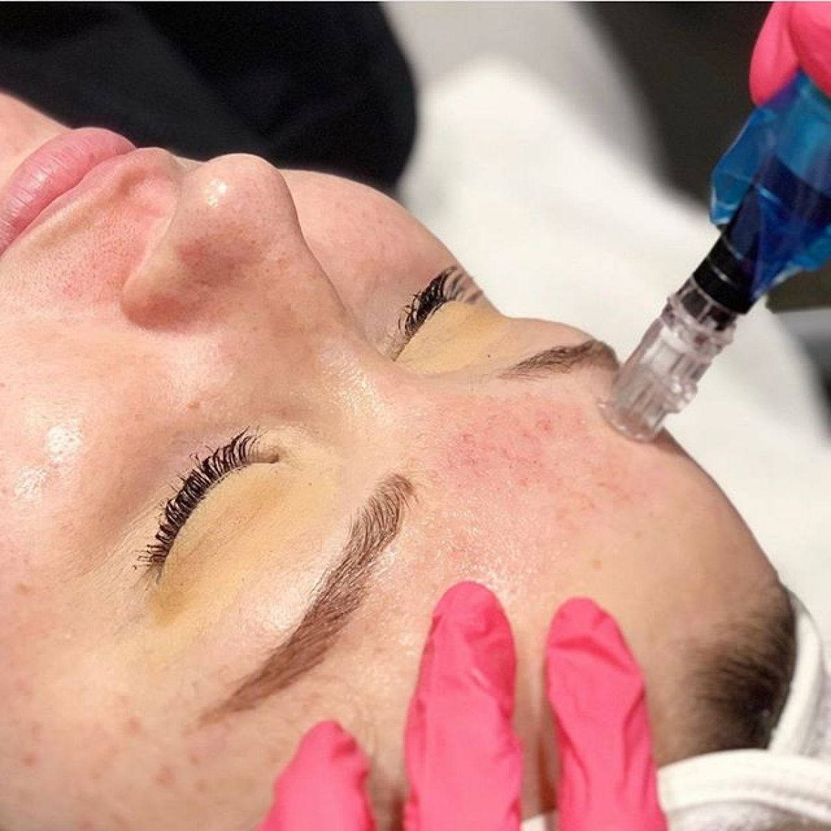 MicroNeedling BB Glow à Tournefeuille (31) Par Manon - Estheca