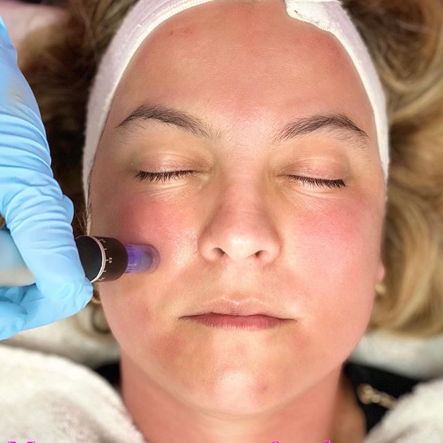 À Pontoise | Microneedling et BB Glow | Les meilleures esthéticiennes