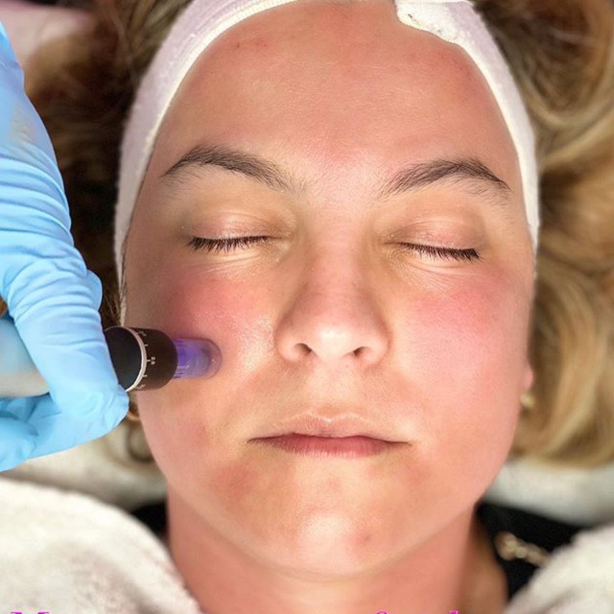 MicroNeedling BB Glow à Condé-sur-l'Escaut (59) Par Manon - Estheca