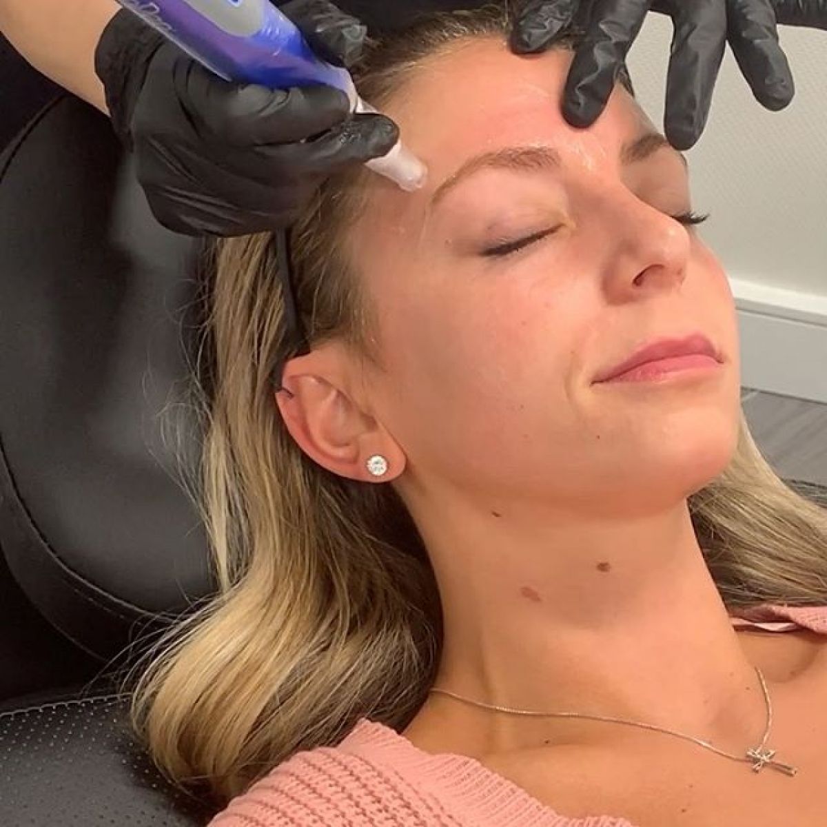 MicroNeedling BB Glow à Ramonville-Saint-Agne (31) Par Gwendoline - Estheca