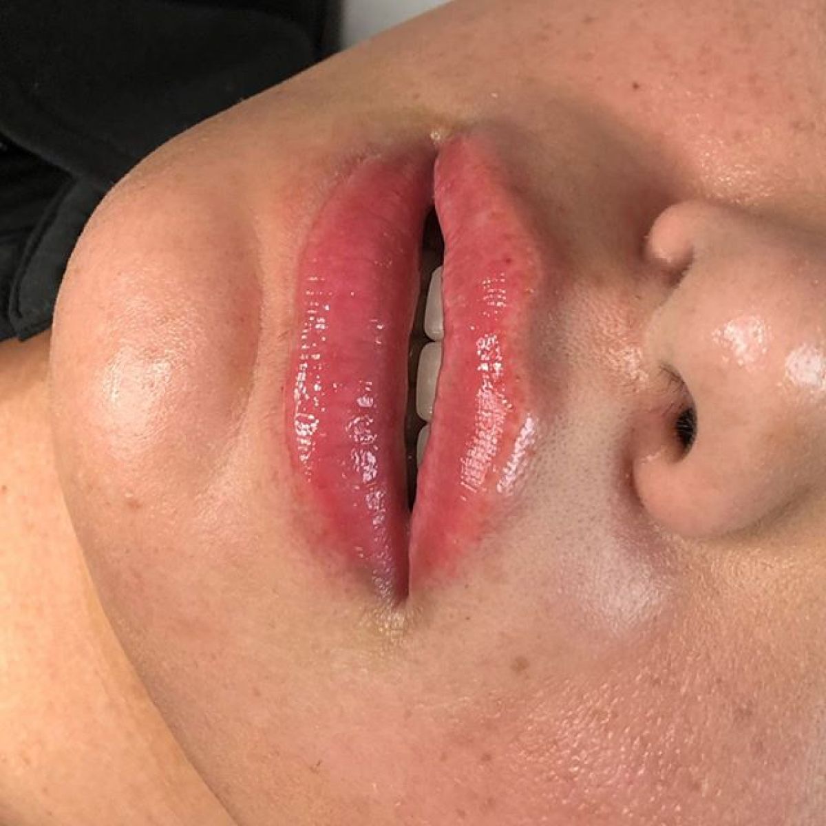 Hyaluron pen à Schiltigheim (67) Par Adeline - Estheca