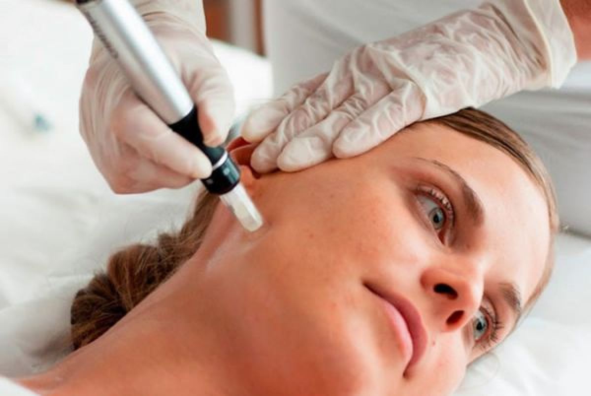 Microneedling/ bb glow/ peeling  à Marcq-en-Baroeul (59) Par Myriam - Estheca