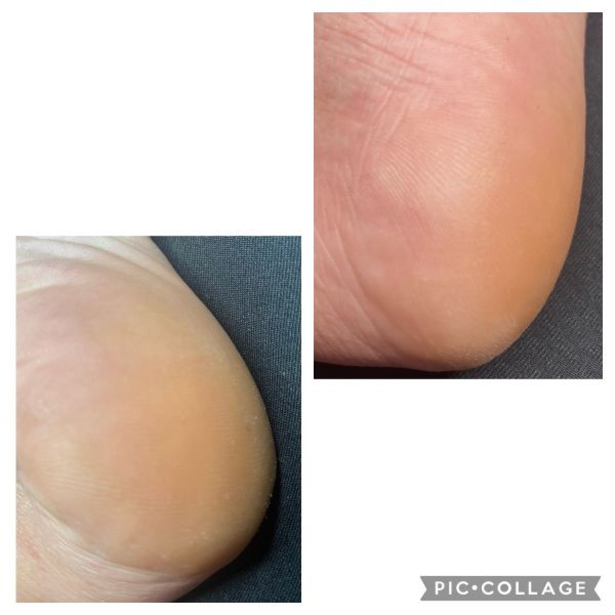 Soin pieds zéro callosités à Cholet (49) Par Liliana - Estheca