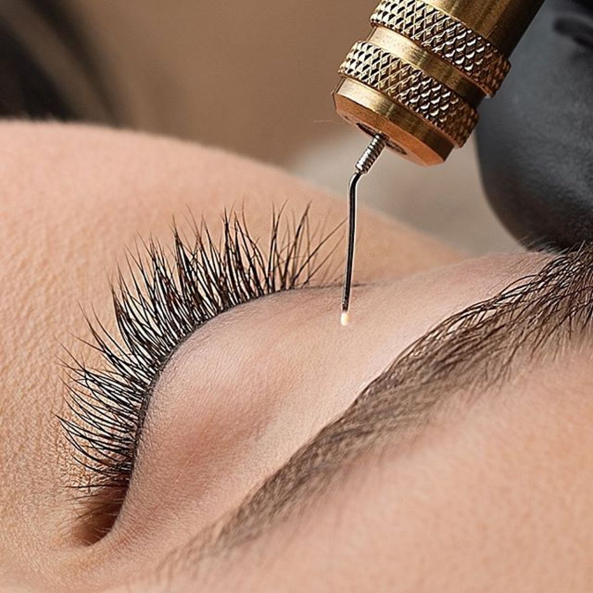 Plasma Lift à Sarcelles (95) Par Hind - Estheca