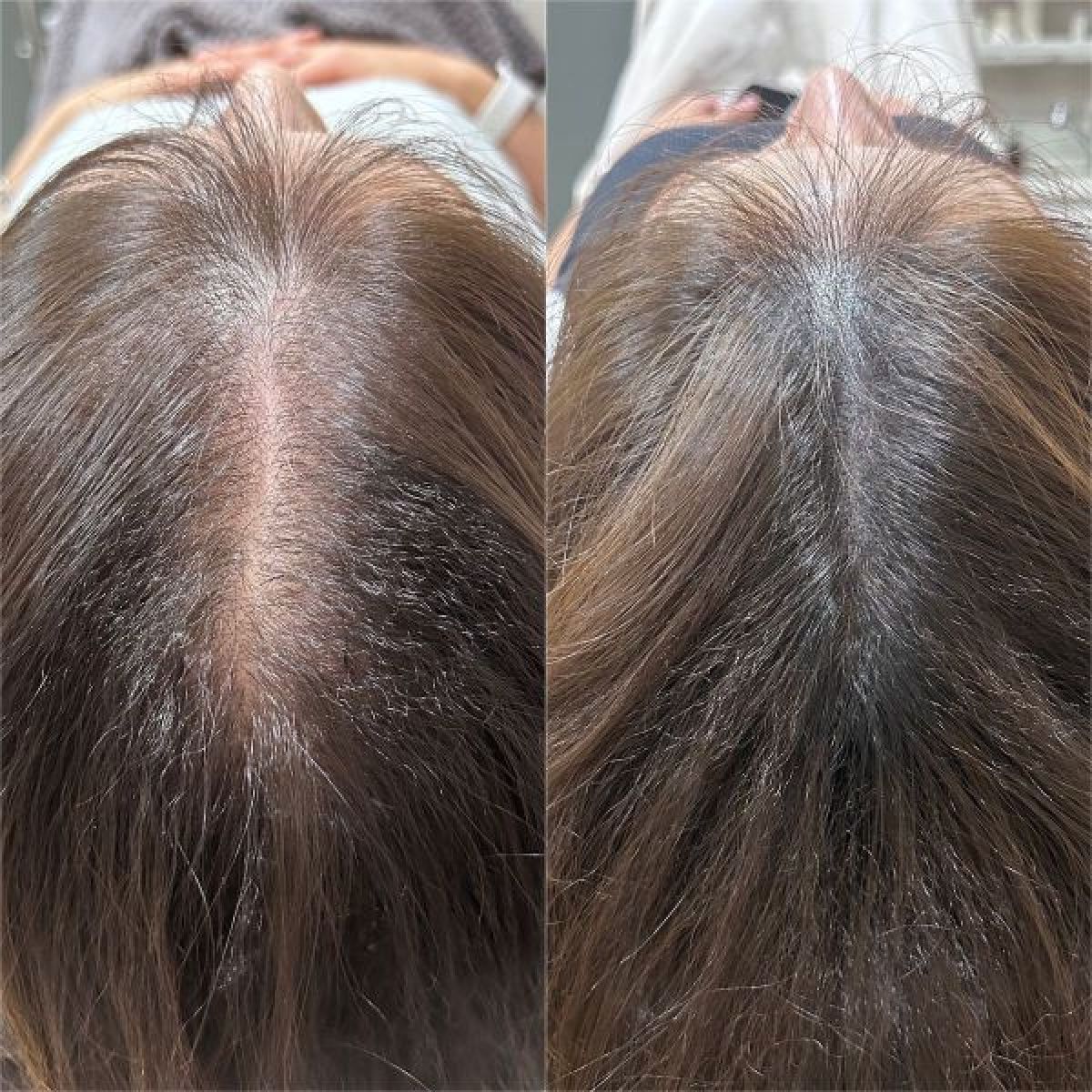 Hair neelding à Vaulx-en-Velin (69) Par Selma - Estheca
