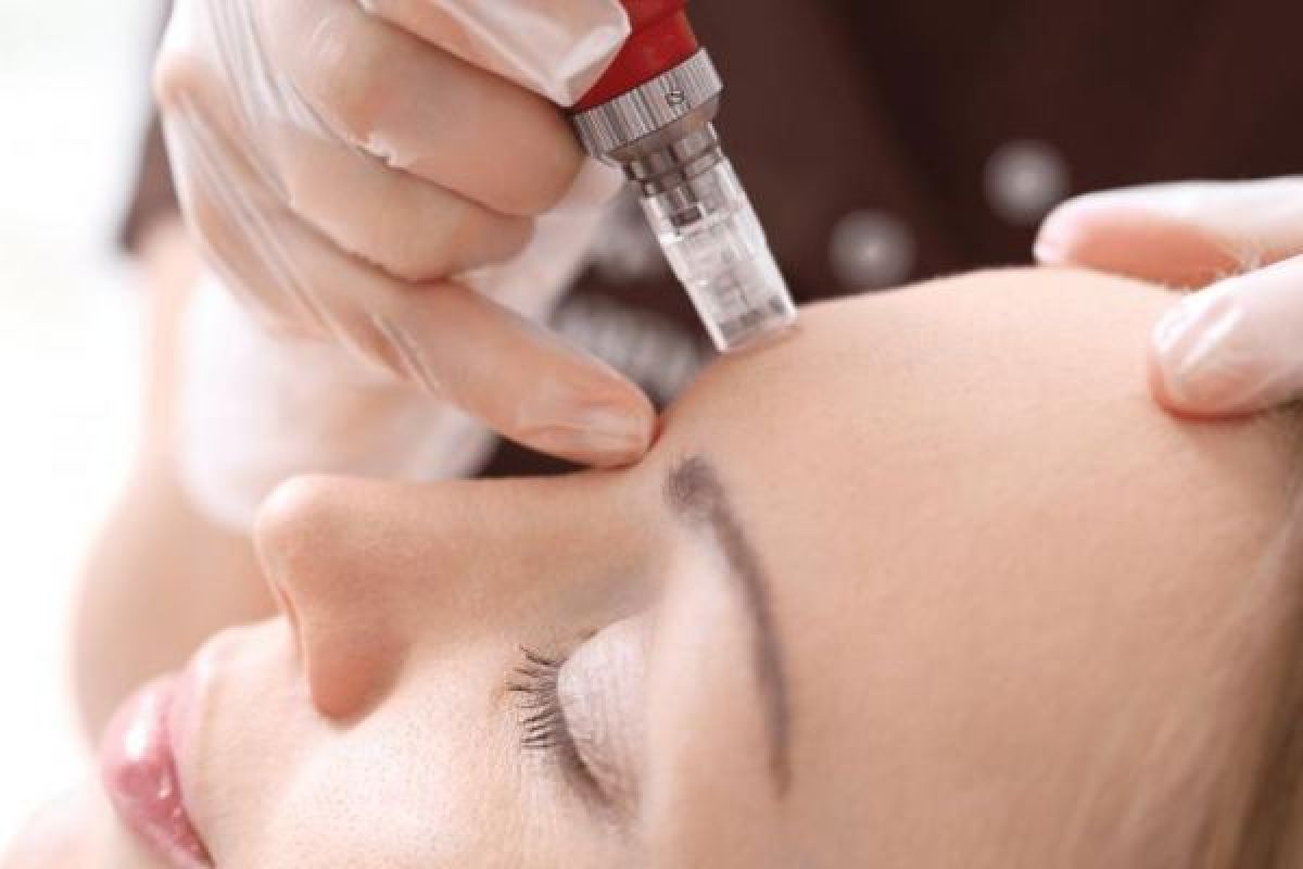 MicroNeedling BB Glow à Bretteville-sur-Odon (14) Par Amandine - Estheca