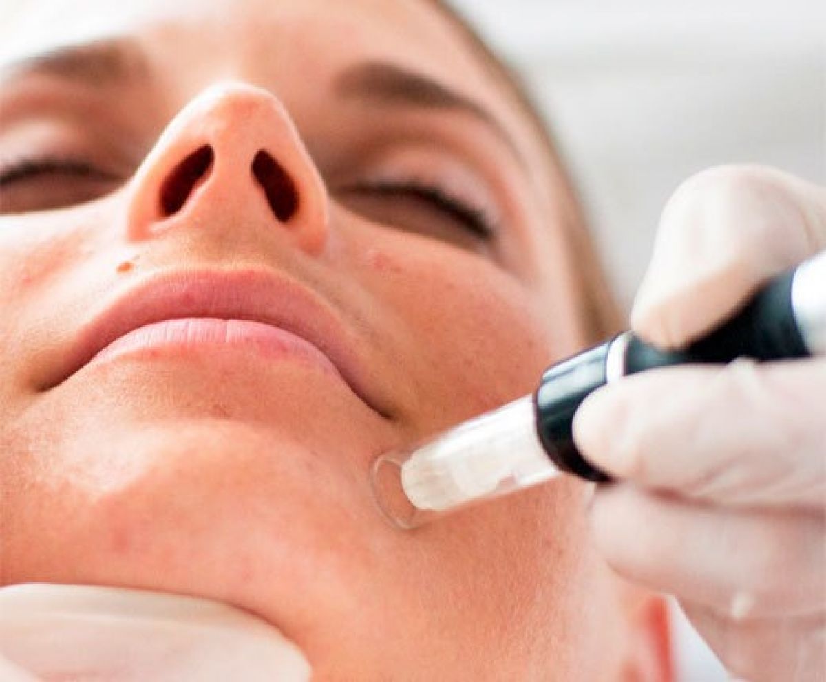 MicroNeedling BB Glow à Valenciennes (59) Par Virginie - Estheca
